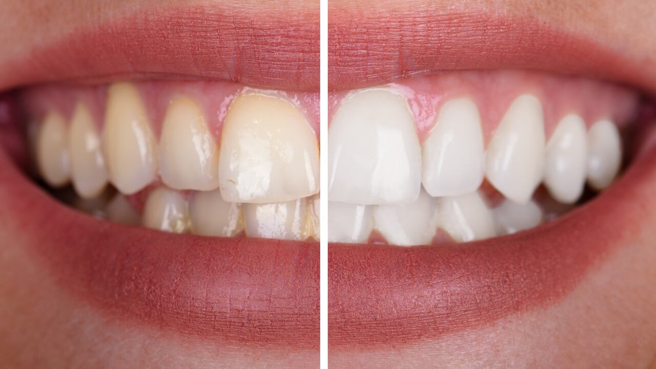 Los dientes amarillos también pueden generar problemas de autoestima.
