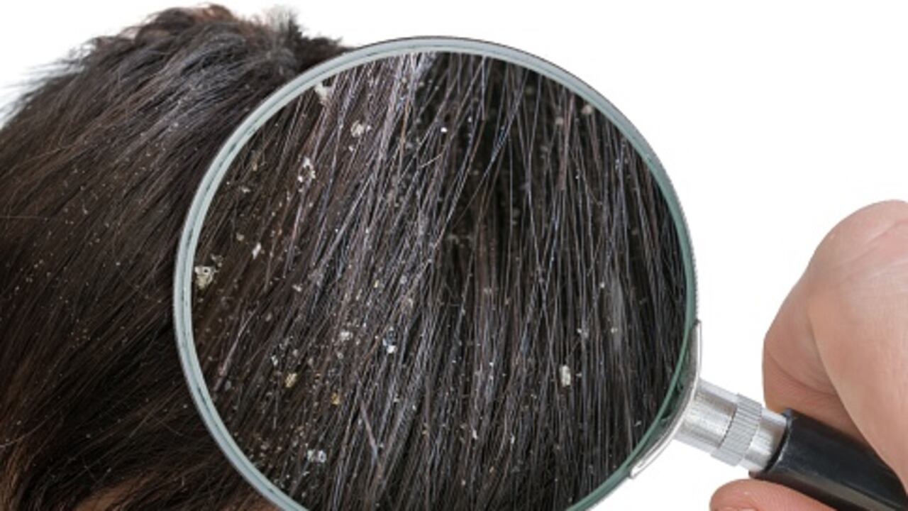 El vinagre de manzana ayuda a eliminar la caspa.