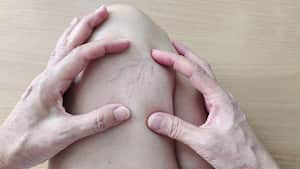 Las venas várices pueden formarse por una mala circulación de la sangre.