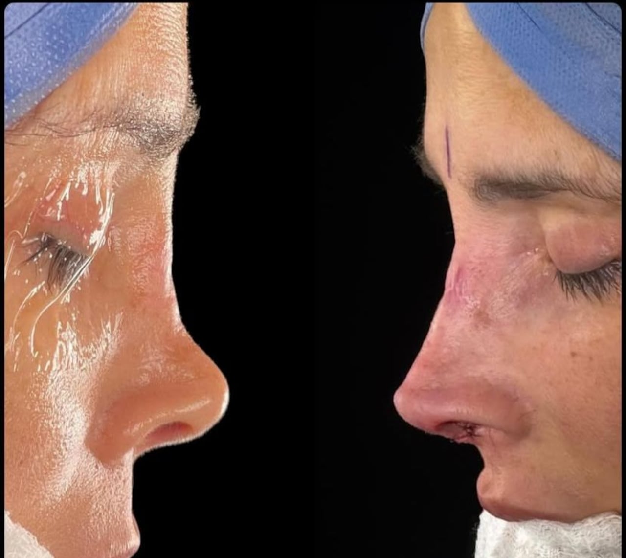 La actriz se sometó por cuarta vez a una intervención quirúrgica de nariz.