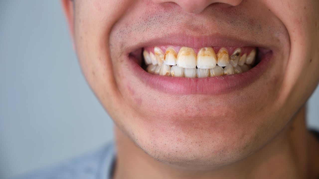 La placa bacteriana de los dientes se endurece hasta convertirse en sarro.