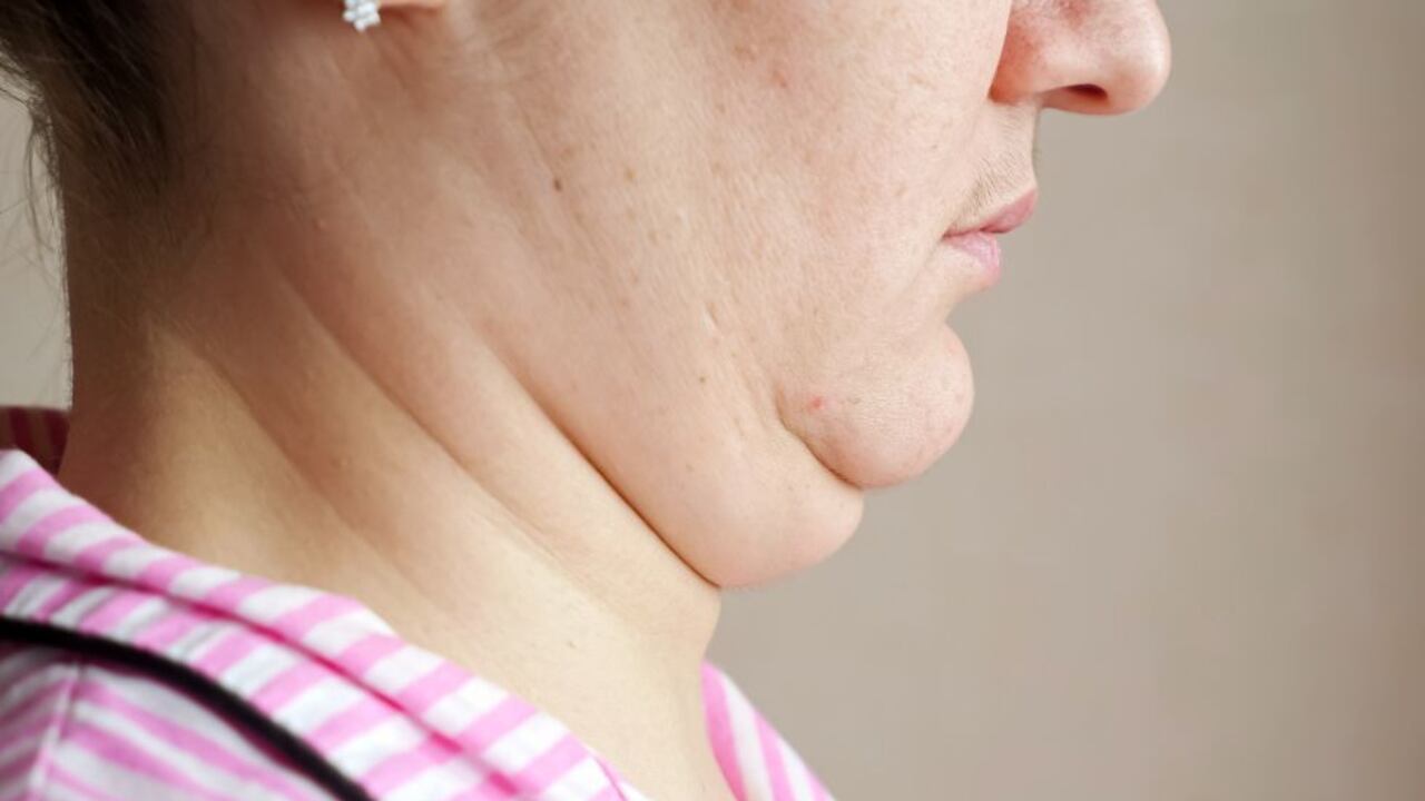 El exceso de peso es una de las principales causas de la papada.