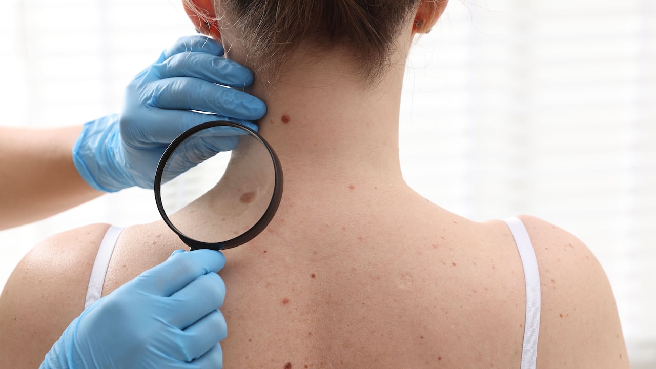 Un diagnóstico oportuno aumenta las posibilidades de tratamiento exitoso frente al cáncer de piel.