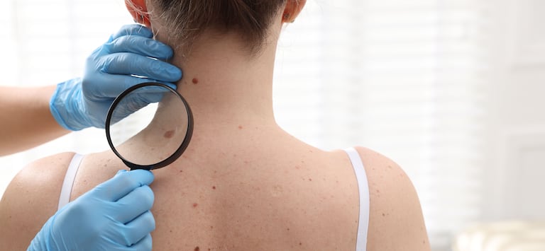 Un diagnóstico oportuno aumenta las posibilidades de tratamiento exitoso frente al cáncer de piel.