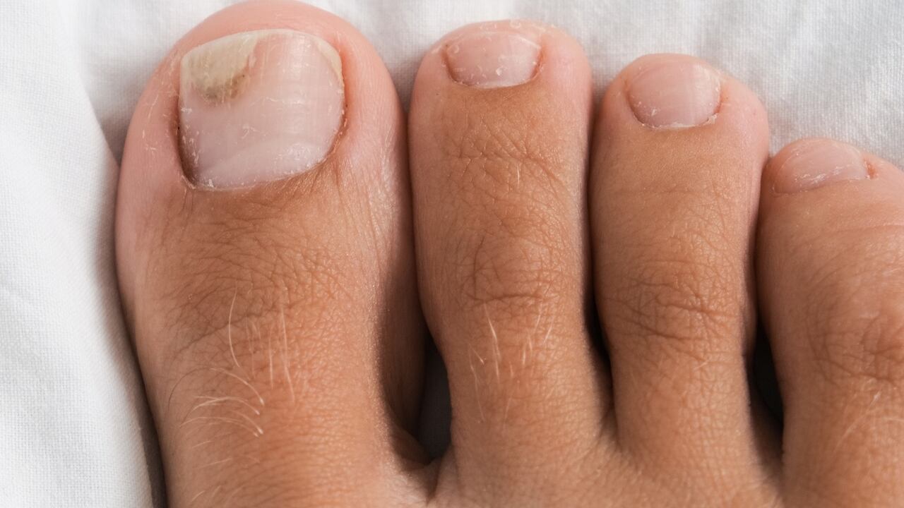 Hongos en uñas de los pies