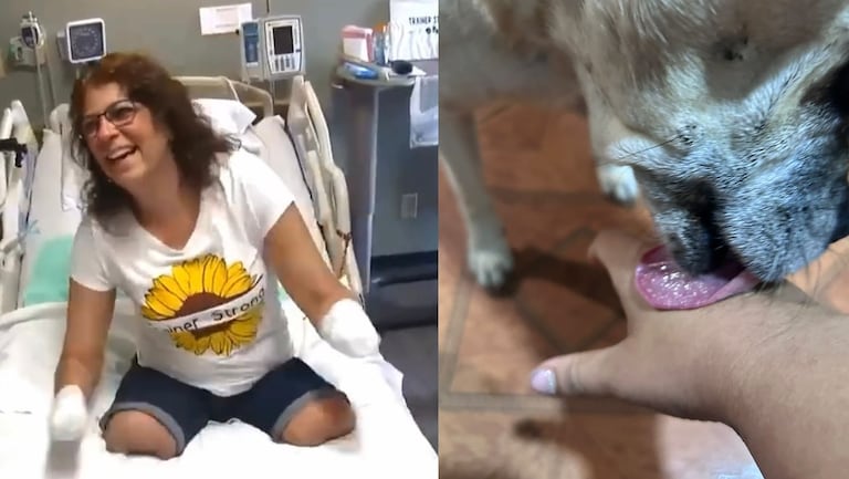 Un lamido que cambió su vida: mujer perdió brazos y piernas tras infección transmitida por su perro