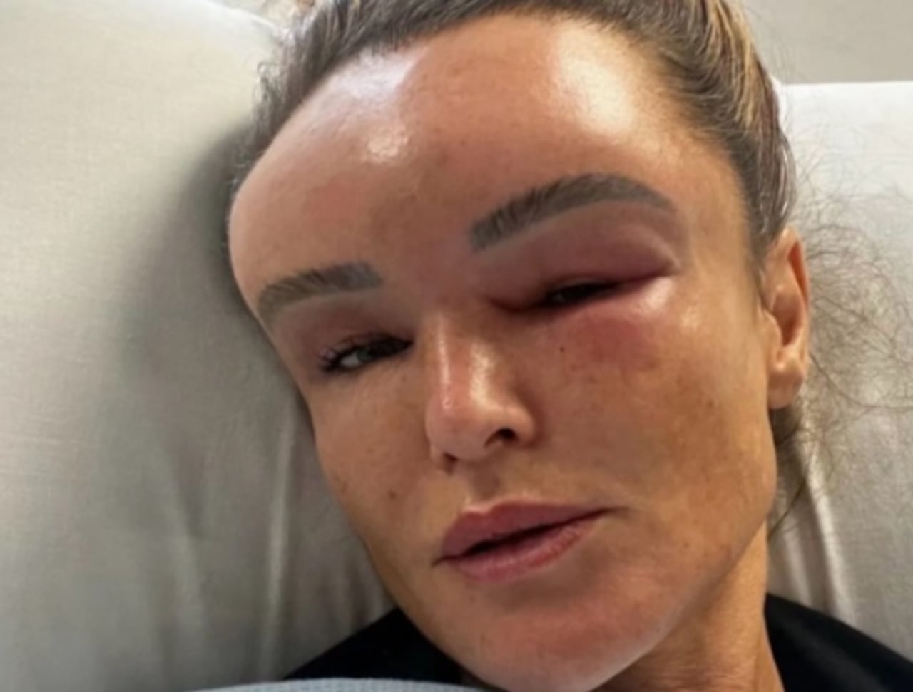 Enfermedad rara desfiguró su rostro tras un accidente: La historia de Claire Titterington.