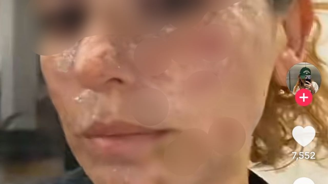 Vanessa Rada sufrió graves quemaduras en su rostro.