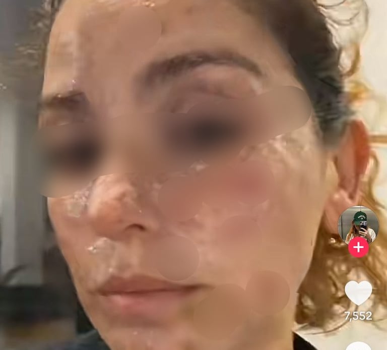 Vanessa Rada sufrió graves quemaduras en su rostro.