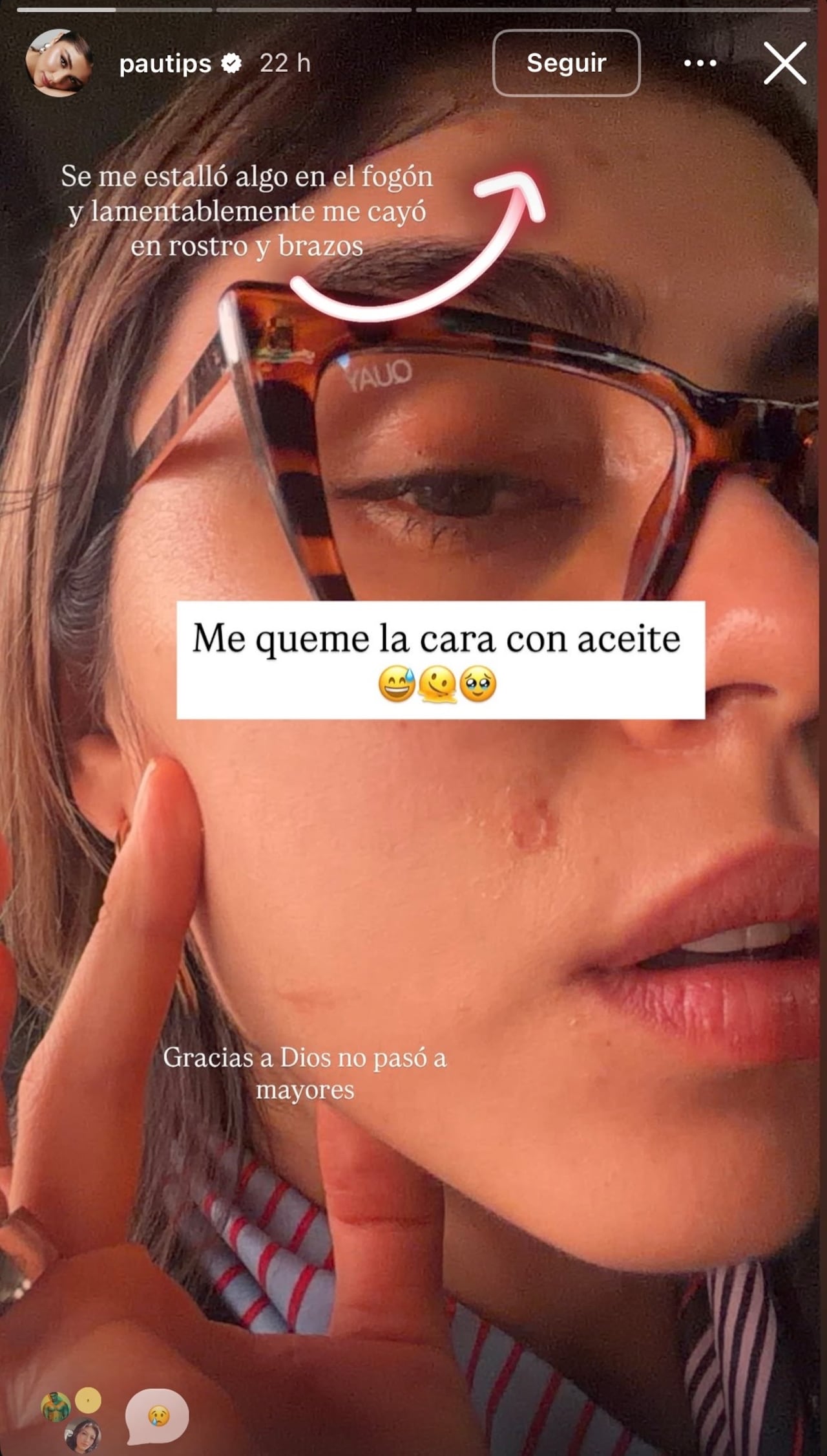 Pautips, de 'MasterChef Celebrity' sufrió quemadura con aceite