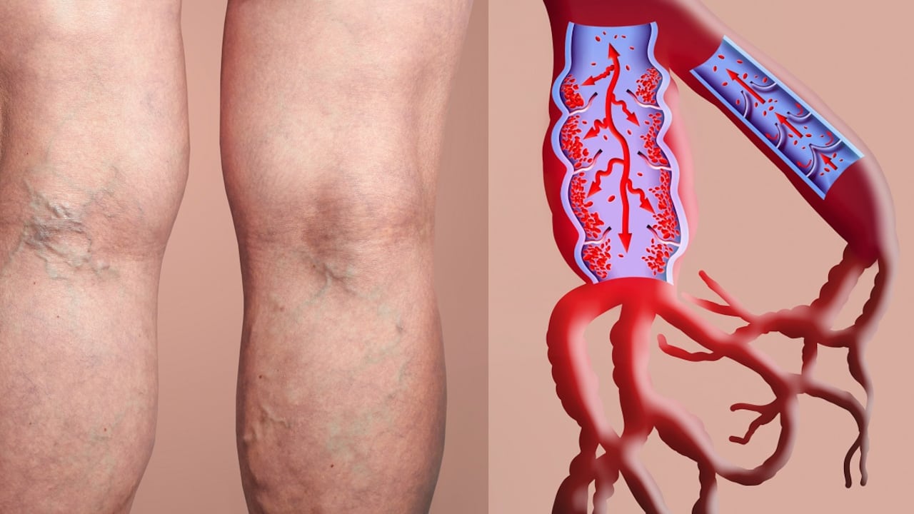 Mala circulación en las piernas