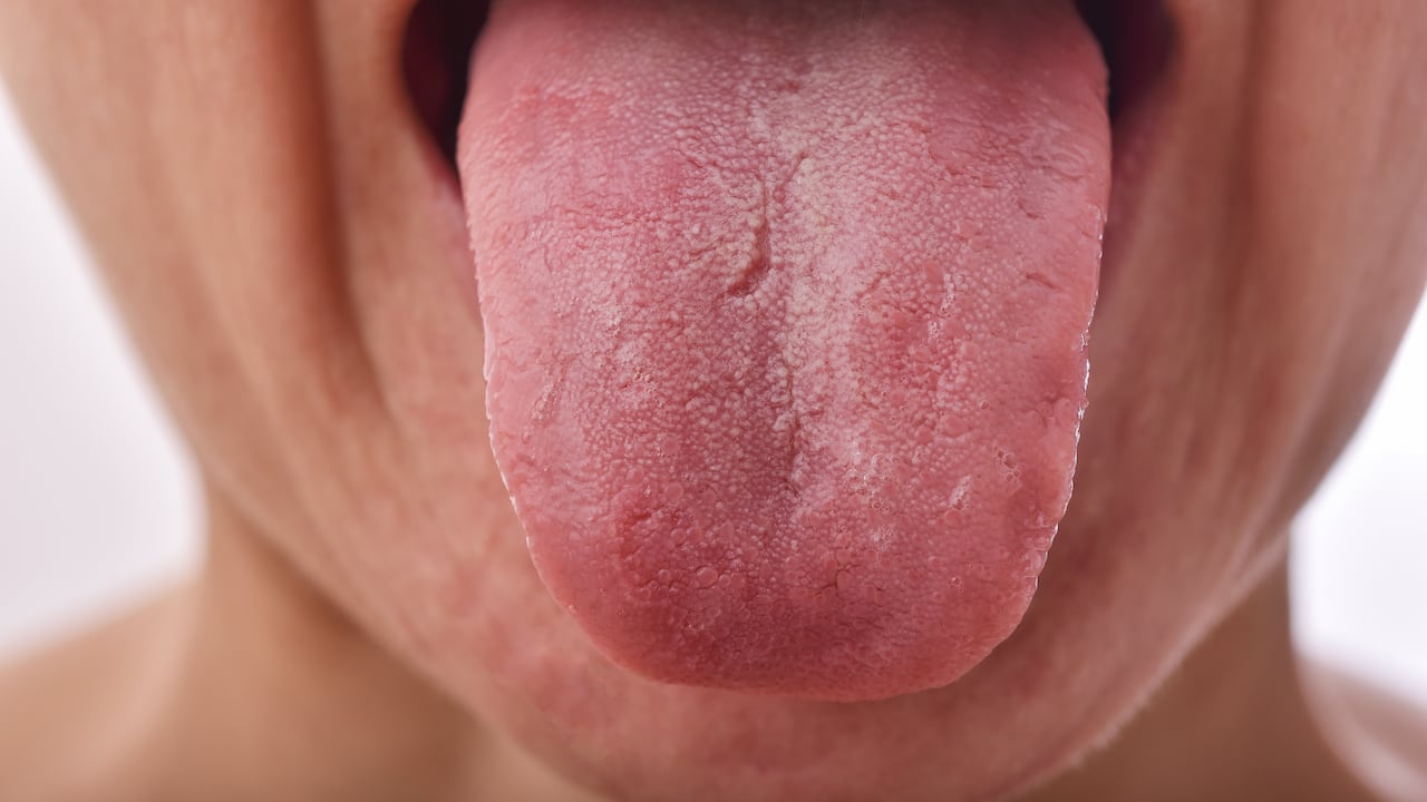 Las fisuras en la lengua causan mal aliento.