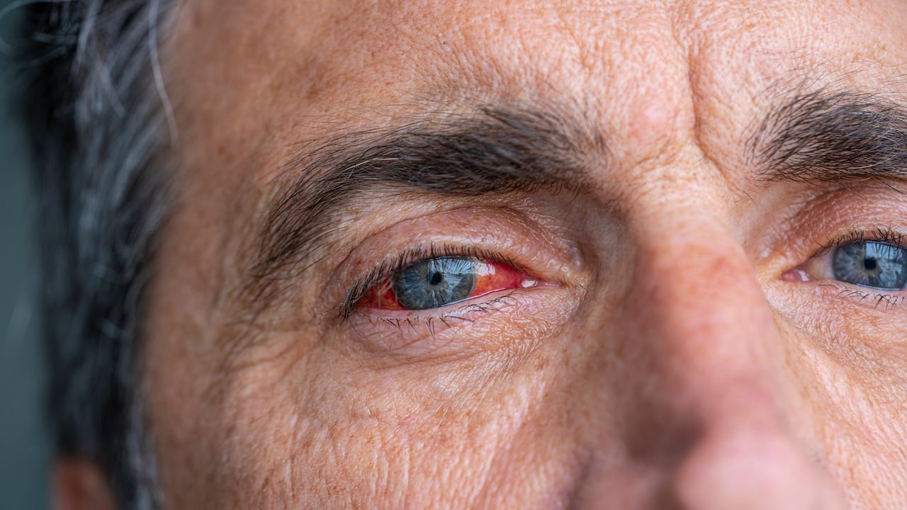 La pérdida de la visión puede desarrollarse por presión arterial alta.