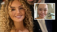 Enfermedad rara desfiguró su rostro tras un accidente: La historia de Claire Titterington.