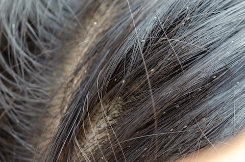 Tanto los piojos como las liendres suelen aparecer en el cuero cabelludo de los niños menores de 11 años de edad.