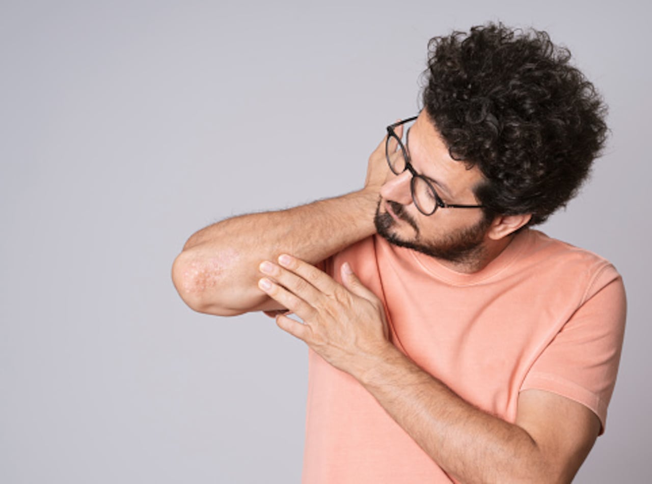 El Síndrome de Sjögren causa codos y ojos secos.