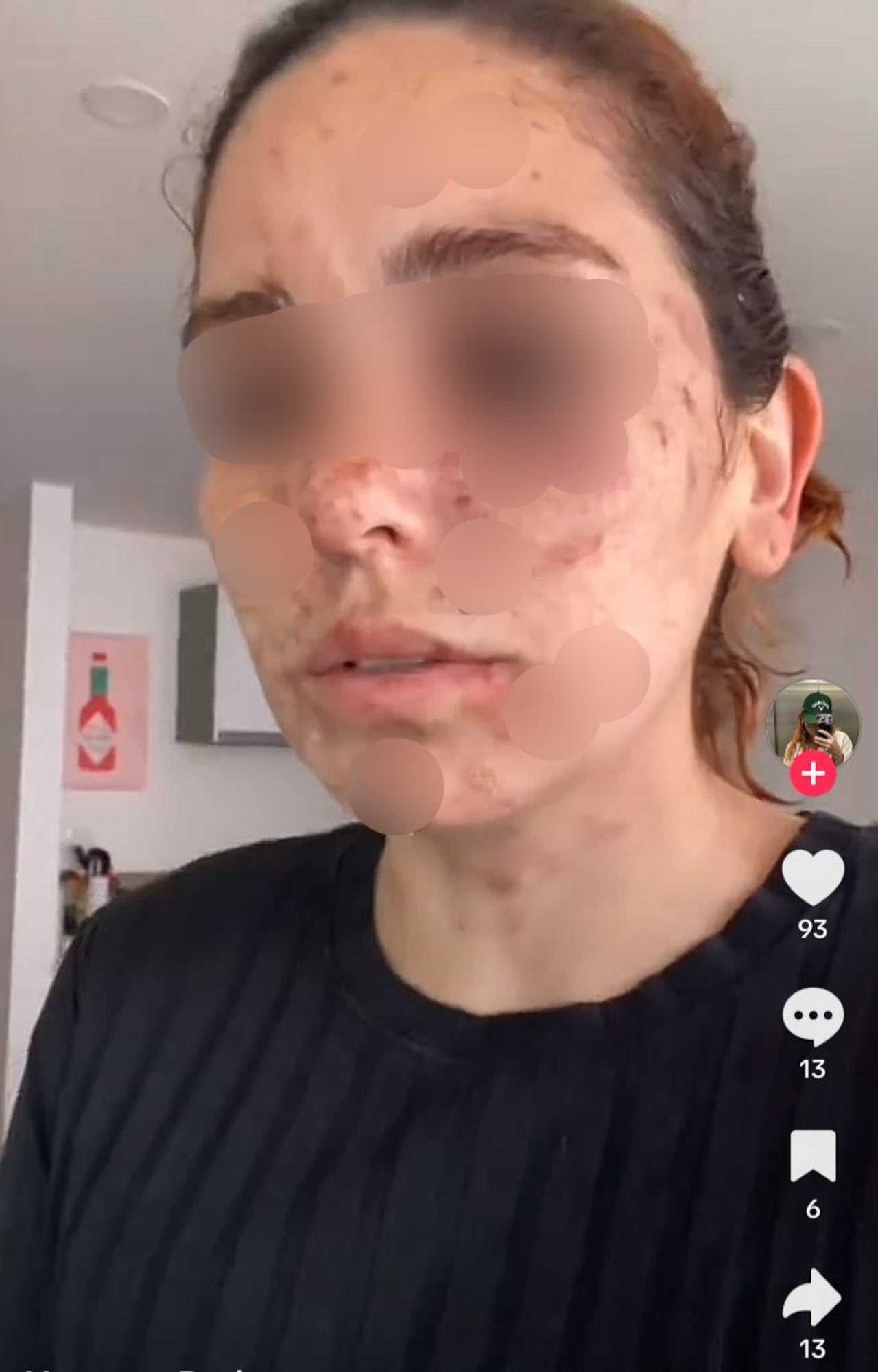 Vanessa Rada sufrió graves quemaduras en su rostro.