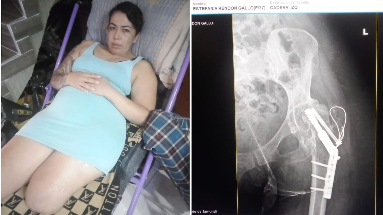 Estefanía Rendón permanece en Jamundí junto a su familia mientras espera la realización de varias cirugías que, según sus allegados, continúan pendientes tras el accidente sufrido en mayo de 2025.