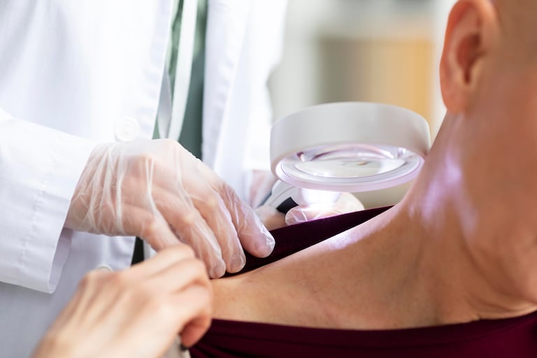 El melanoma es el tipo de cáncer de piel que causa el mayor porcentaje de mortalidad.