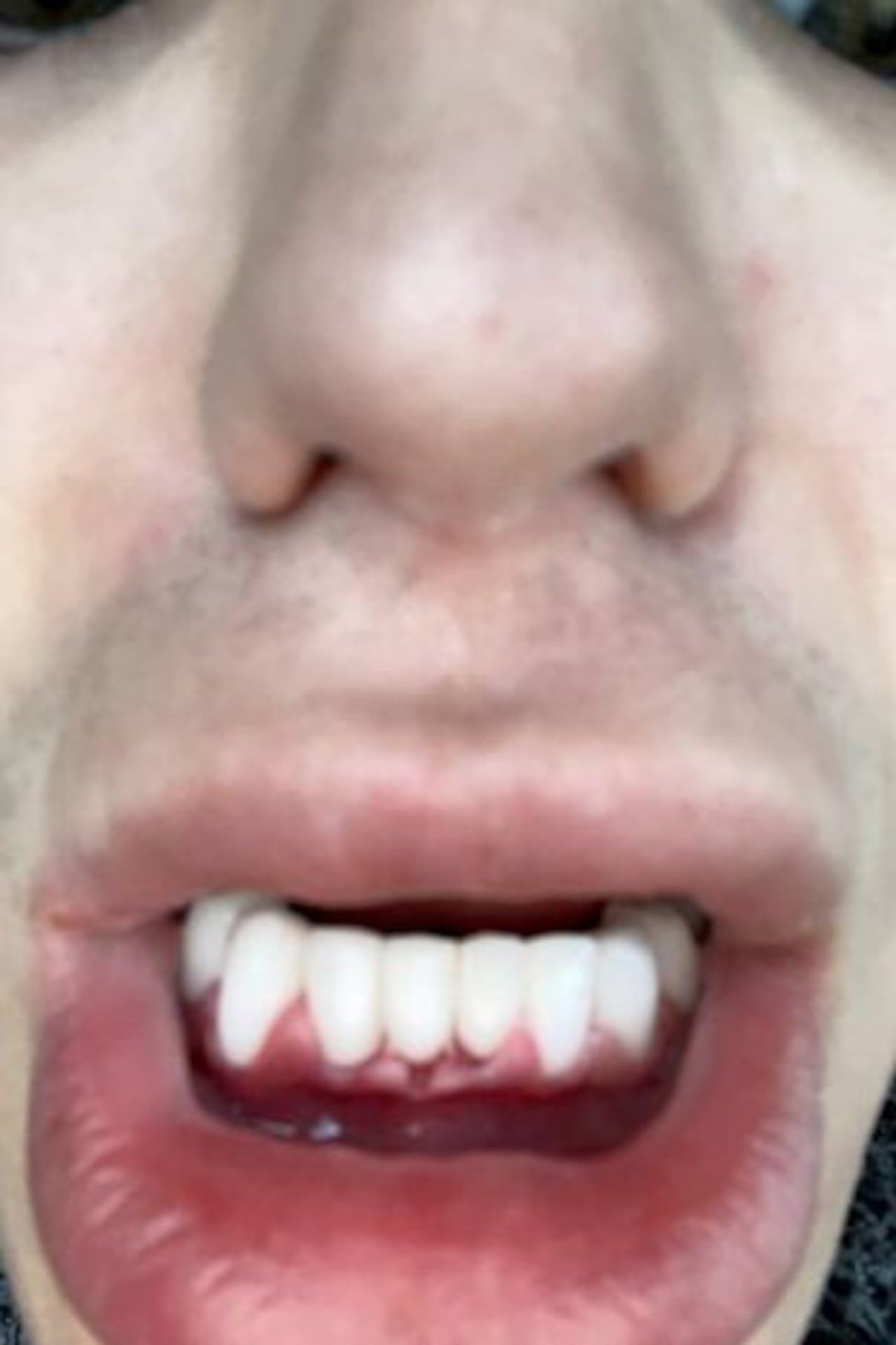 Luego de ponerse las carillas, padeció mal aliento.