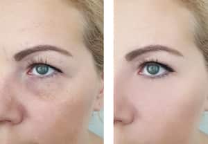 Con la combinación de dos aceites esenciales, se pueden reducir significativamente las ojeras y las arrugas.