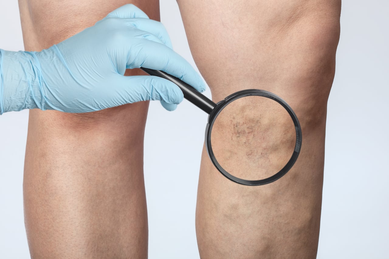 venas hinchadas y retorcidas que pueden verse bajo la piel y suelen aparecer en las piernas.