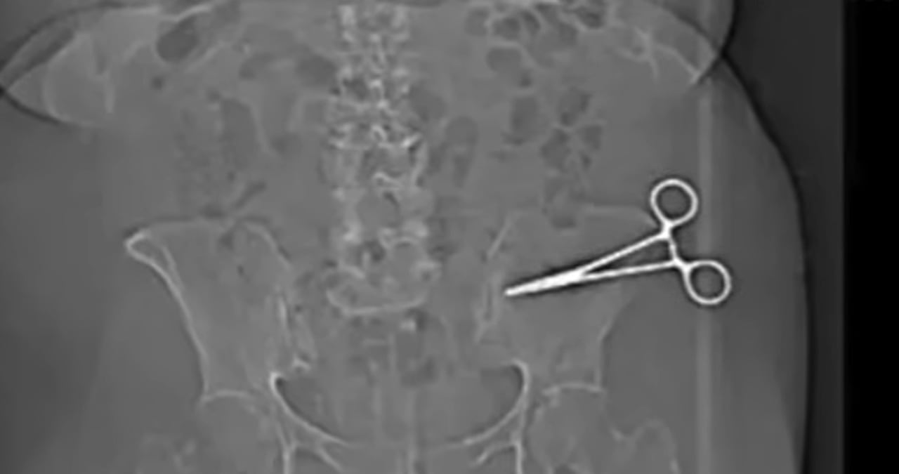 Mujer fue intervenida por tener tijeras en su abdomen.