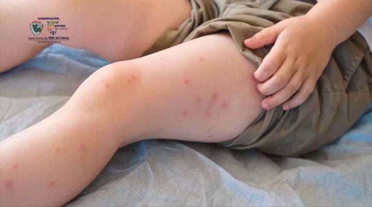 Activan plan de contingencia en el Valle por casos de sarampión en Colombia