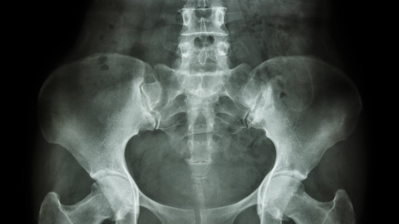 Radiografía de pelvis