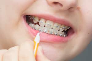 Es importante lavar bien los dientes con brackets.