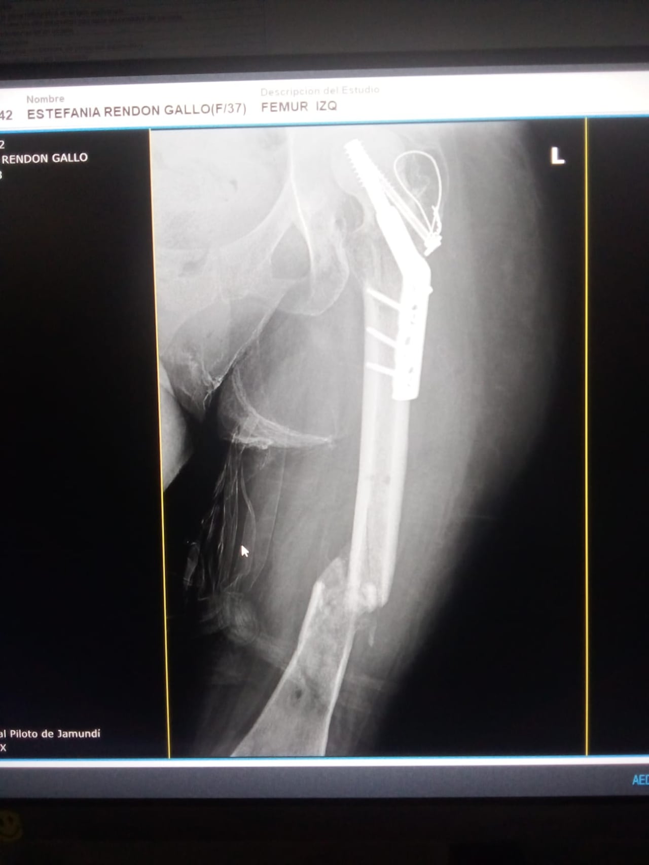 Tras el accidente de tránsito, la mujer fue sometida a múltiples intervenciones quirúrgicas y continúa a la espera de nuevos procedimientos.