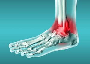 El ejercicio también es uno de los factores que puede ayudar a reducir la inflamación y el dolor en las articulaciones.