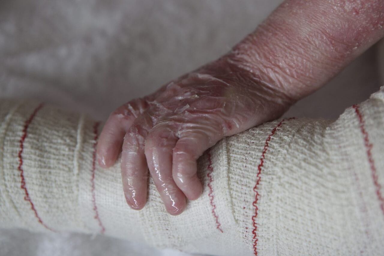 Lo niños suelen ser los más afectados por esta condición.