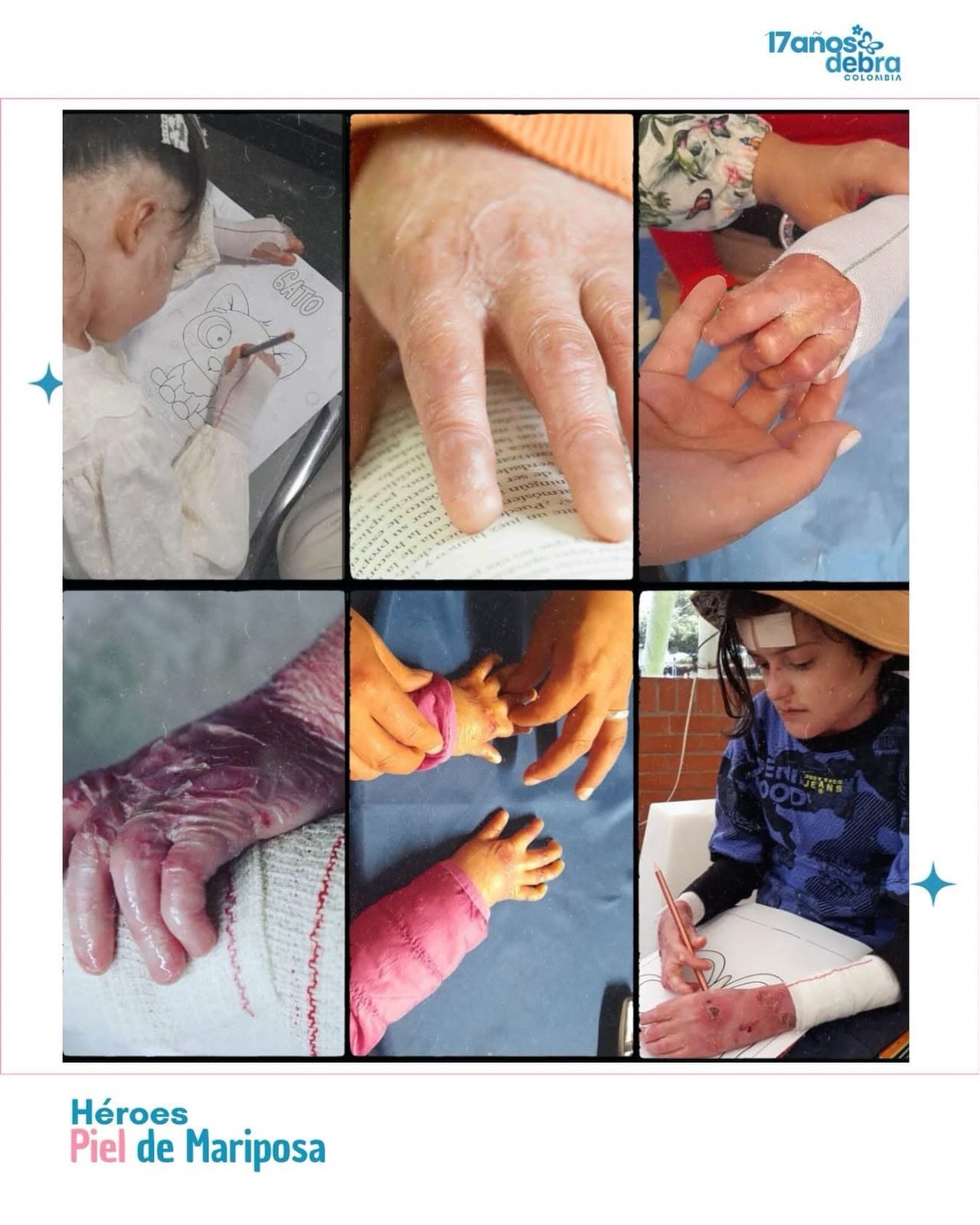 La constante aparición de lesiones de difícil cicatrización expone de manera permanente a los pacientes a dolores crónicos, desnutrición por la dificultad para ingerir alimentos, anemia, fusiones en las articulaciones de los dedos y un riesgo crítico de infecciones generalizadas.