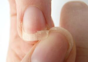 Las uñas débiles y quebradizas son uno de los casos más comunes. Cuenta oficial @dosfarma