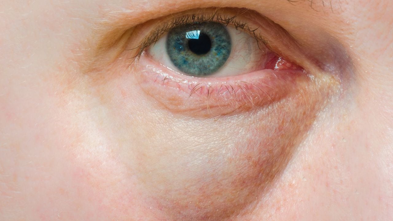 Cuide sus ojos de manera natural: remedios caseros para disminuir las bolsas oculares y su preparación
